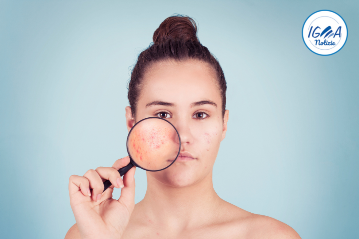 Come prevenire l’acne con una corretta alimentazione: alcuni consigli utili