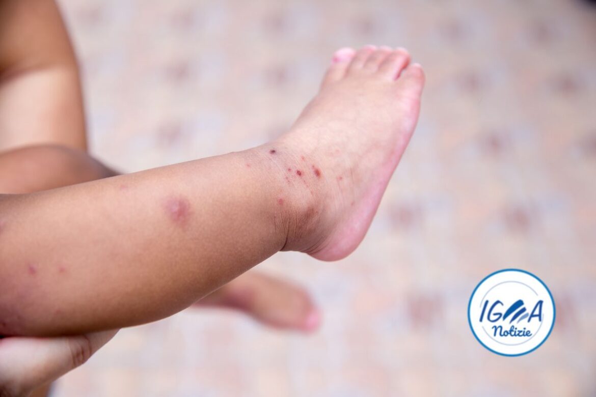 Malattia mani-bocca-piedi: un’infezione virale che colpisce bambini e adulti
