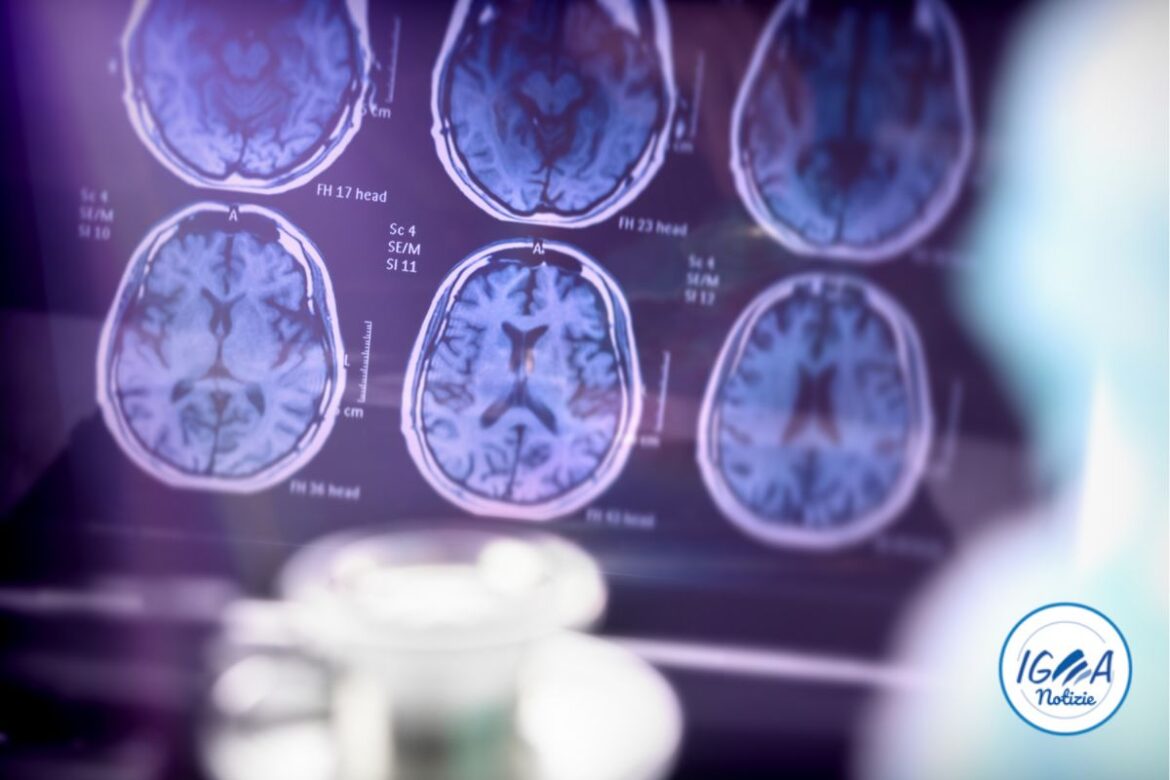 Nuova scoperta: un gene potrebbe proteggere il cervello dall’Alzheimer